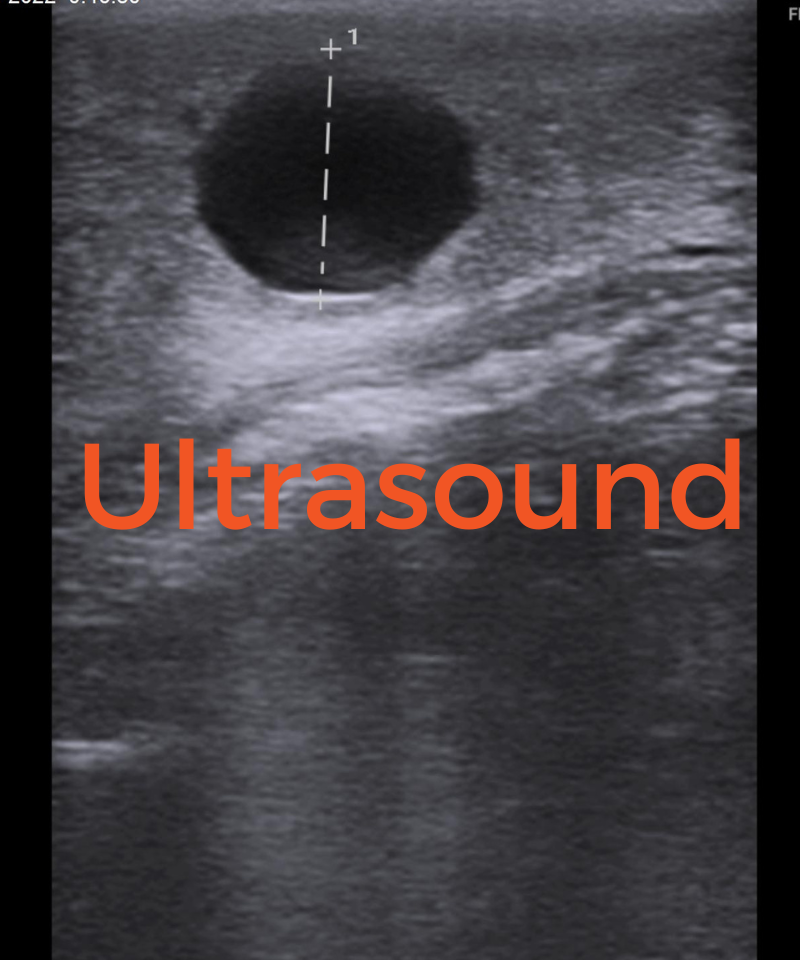 Ultrasound